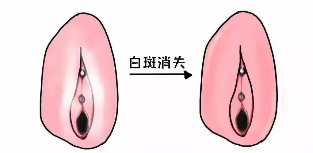 治疗外阴白斑医院排名
