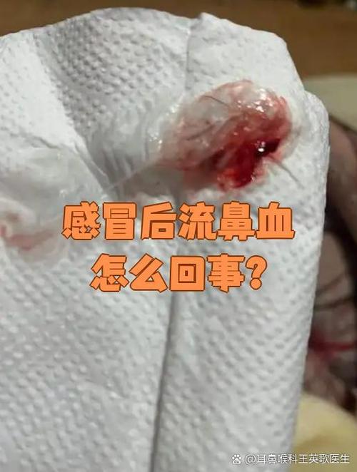 像流鼻血一样流黄鼻涕