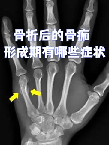 骨头多久会完全消失