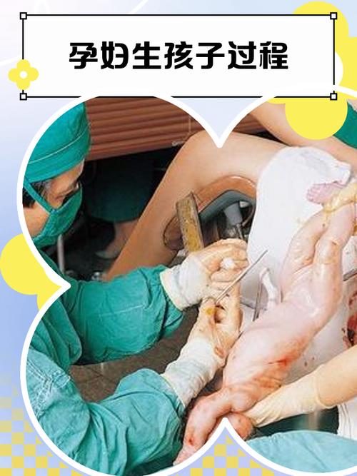 URJJ孕妇线生孩子