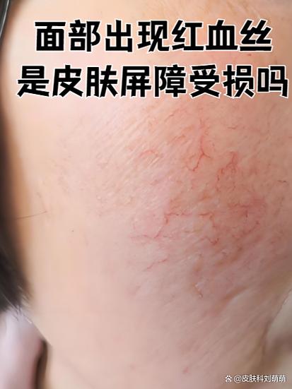 脸颊有蚂蚁爬感要警惕