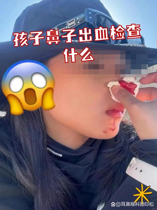 鼻子经常流鼻血