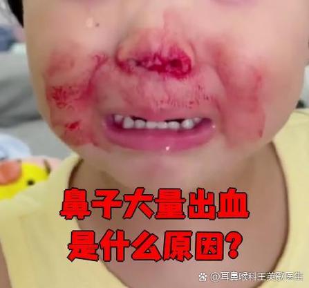 一支鼻子流鼻血