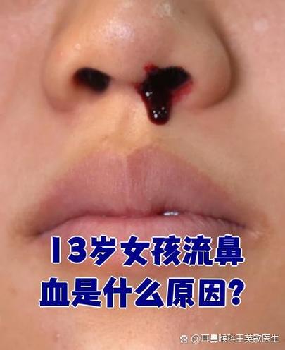 最近鼻子痒流鼻血