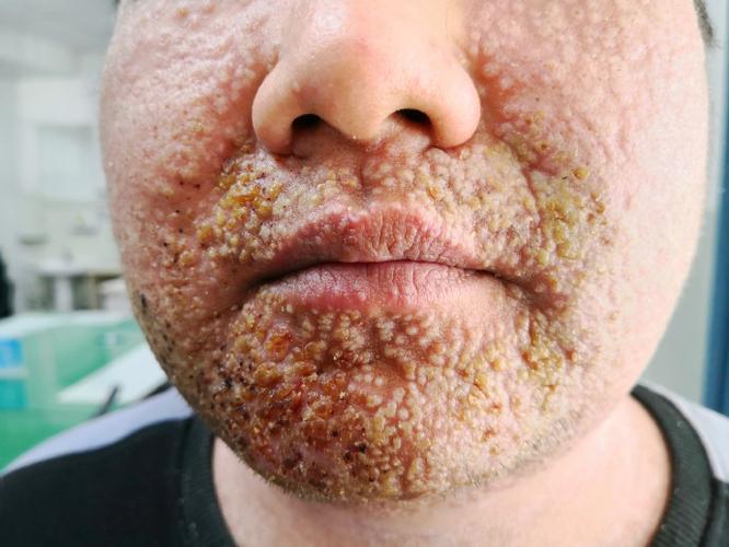 特应性皮炎图片及症状