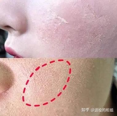 上粉底后脸上起皮怎么办