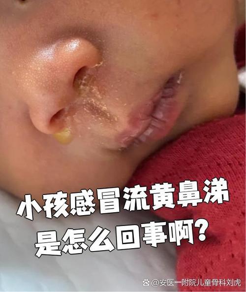 鼻子不通气,流黄鼻涕