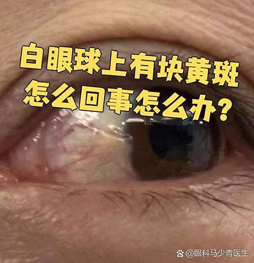 眼白有黄斑是怎么回事