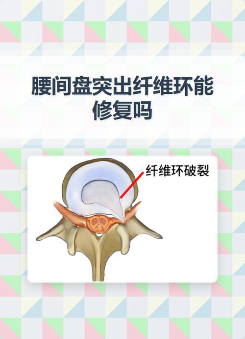 纤维环撕裂需要手术吗