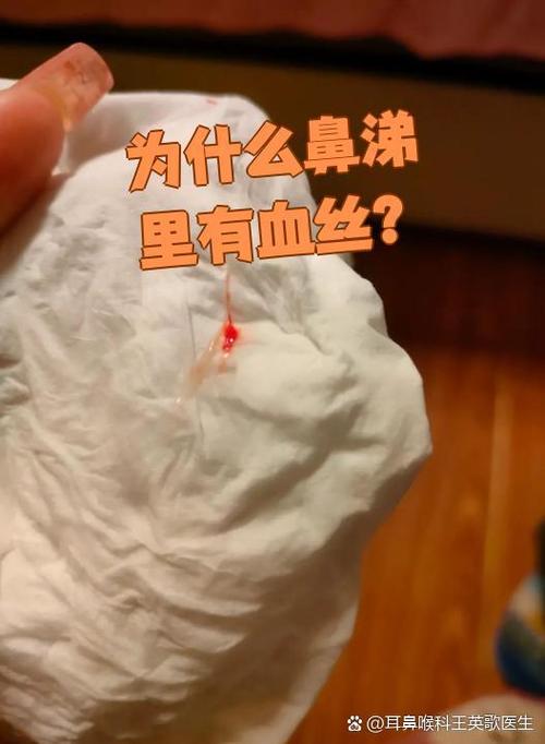 鼻涕里带血但是没流鼻血发低烧