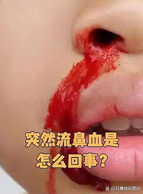 从没流鼻血突然流鼻血
