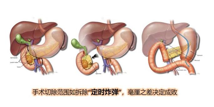 痛了三个月才查出胰腺问题