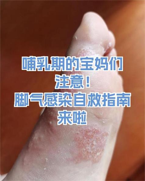 哺乳期妈妈怎么去脚气
