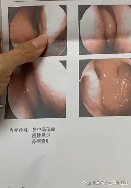 突然流鼻血的原因