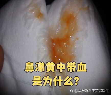 鼻子有黄浓鼻涕带血