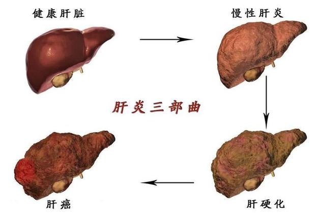 乙肝病毒对人体的影响