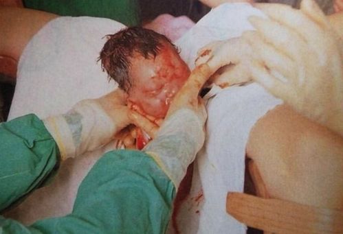 孕妇生孩子生不出来
