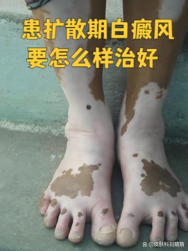 屏幕白斑会越来越大吗