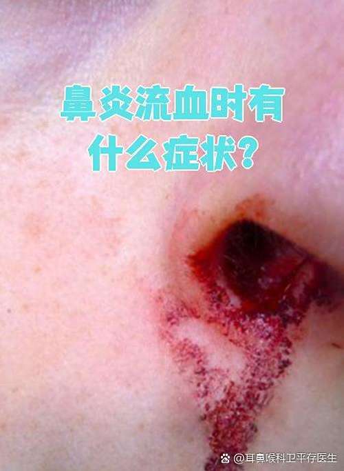 鼻子太干燥流鼻血