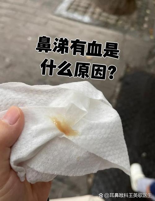 鼻涕有血但不流鼻血