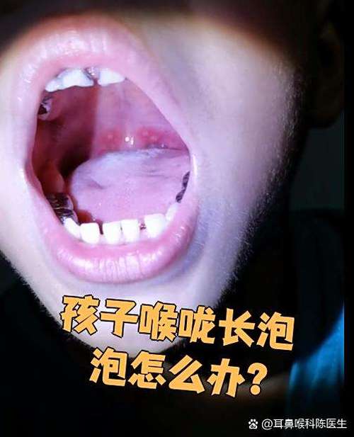 嗓子有小泡泡是病毒吗